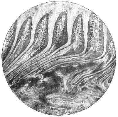 Fig. 101.   Perpendicular Section Of The Wall Of A Contracted Quarter In A Case Of Chronic Corn