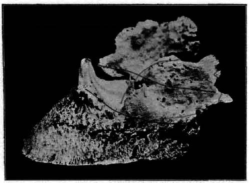 Fig. 143. Ossified Lateral Cartilages (Side Bones)