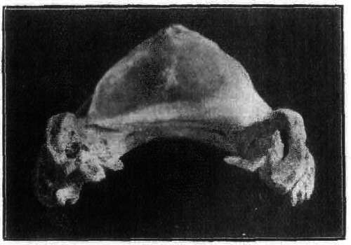Fig. 152. Effects Of Periostitis On The Os Pedis