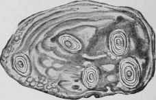 Section of Vesical Calculus.
