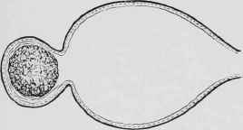 Stone Empouched in the Fundus of the Bladder.