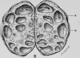 Cystic Ovary.