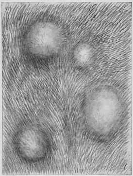 Urticaria.