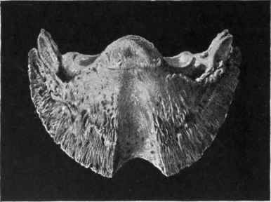 Keratoma or Horn Tumour.