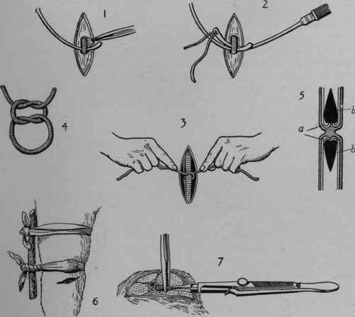 Various Methods of Arresting Bleeding.