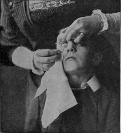 Fig. 1. Removing a grain of dust from the eye blowing the nose very hard sometimes drains away the tears with the hard granule. Failing se simple remedies, help must be given by