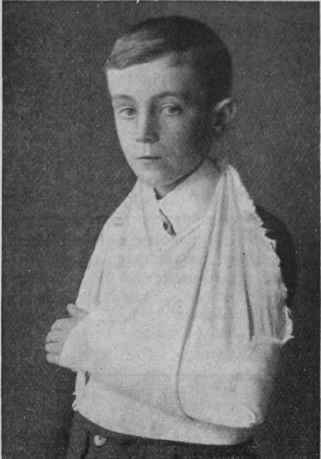 Fig. 4: For a fractured rib a towel folded into a on the injured side supported in a broad sling