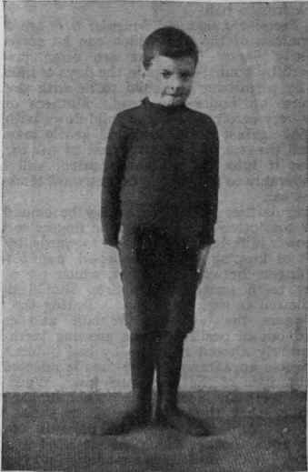 To cure an ' intoed foot, sharply bend the foot outwards , then inwards until the inner borders of the feet are touching