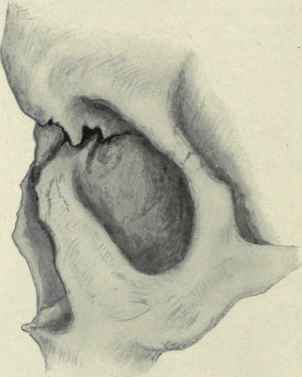 Fig. 114 Fracture of the nose showing depression of the nasal bone.