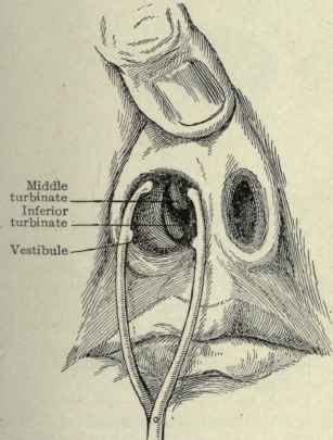 Fig. 116. Examining the anterior nares. Middle and inferior turbinates exposed to view.