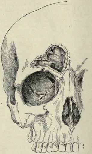 Fig. 15.   Frontal sinus of one side; the anterior wall has been cut away, exposing its interior.