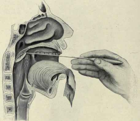 Fig. 159. Examining the interior of the larynx by means of the laryngoscopic mirror.