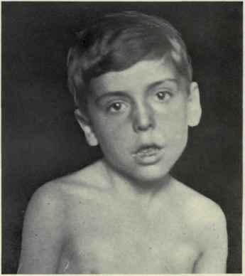 Fig. 170. Torticollis or wry neck.