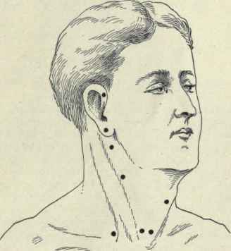 Fig. 189. Points of opening of sinuses originating from the thyroglossal duct and branchial clefts. (Modified from Sutton).