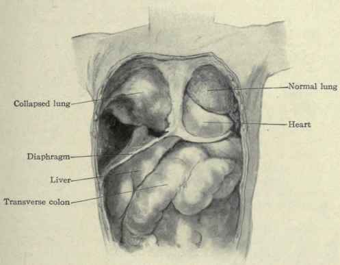 Fig. 217. Formalin hardened body, showing the right lung collapsed and compressed by a large pleural effusion.