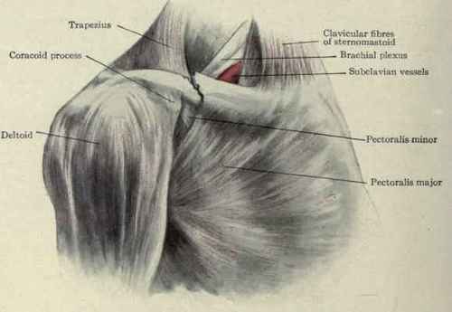 Fig. 257. Fracture of the clavicle just outside the middle. The outer fragment is displaced downward and inward and the inner fragment upward. The brachial plexus and subclavian vessels are behind the inner end of the outer fragment.