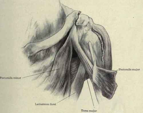 Fig. 259. Fracture of the outer end of the clavicle. The outer fragment is drawn inward by the pectoralis major latissimus dorsi, and teres major muscles.