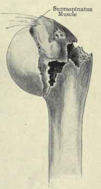 Fig. 262. Detachment of the epiphysis of the upper end of the humerus.