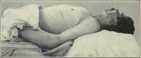 Fig. 276. Subpectoral abscess.