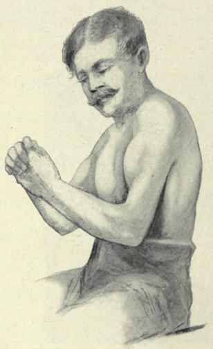 Fig. 282. Rupture of the lower tendon of the biceps. Contraction of the muscle produces a swelling abnormally high up on the arm. (From a photograph).