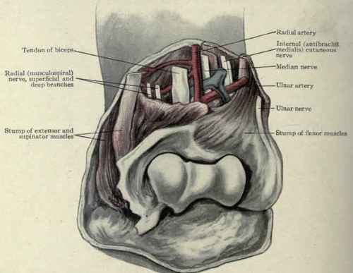 Fig. 317. Amputation at the elbow joint.