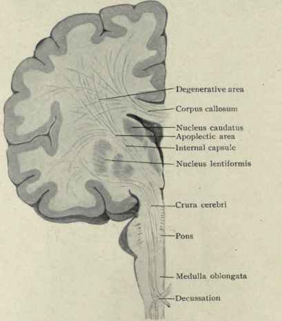 Fig. 34. Showing the degenerative and apoplectic areas of the brain and the course pursued by the motor fibres from the cortex, through the internal capsule, crura, pons, and medulla to the decussation, where they cross the median line to supply the opposite side of the body.