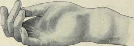 Fig. 352. Compound ganglion showing swellings above and below the anterior annular ligament. (From author s sketch of a tuberculous case).