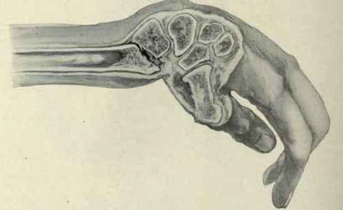 Fig. 353.   Colles's fracture of the lower end of the radius, showing the silver fork deformity and displacement of the fragments.