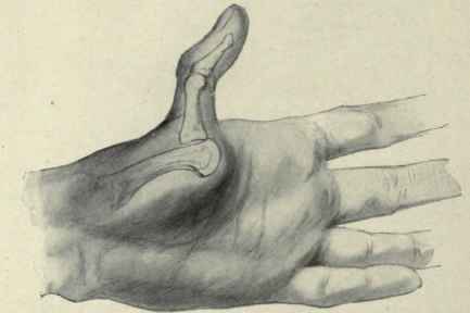 Fig. 376. Dorsal luxation of the proximal phalanx of the thumb, showing the position of the bones.