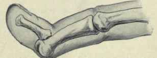 Fig. 378. Dislocation of the terminal phalanx, showing the position of the bones. (From author's sketch).