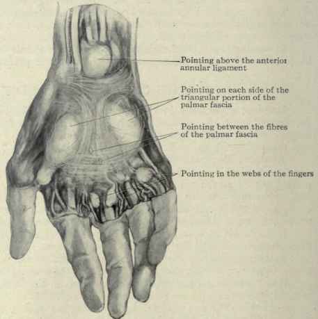 Fig. 379. Cadaveric preparation with wax injected beneath the palmar fascia to illustrate where palmar abscesses tend to find an exit.