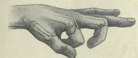 Fig. 384. Lines of incision for amputations at the carpometacarpal joint of the thumb, the metacarpophalangeal joint of the index finger and between the proximal and middle phalanges of the middle finger.