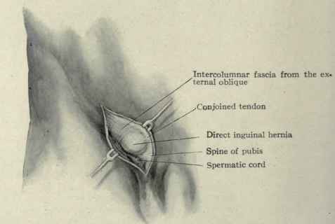Fig. 400. Direct inguinal hernia.