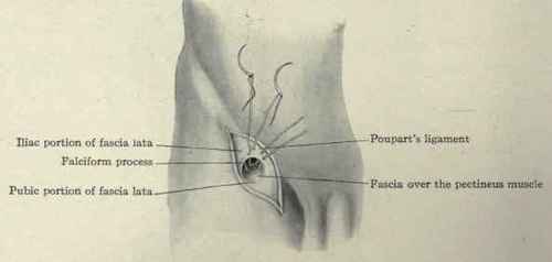 Fig. 406.   Operation for the radical cure of femoral hernia.
