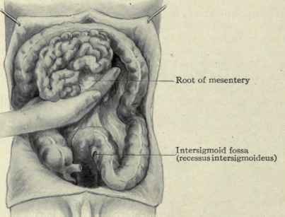 Fig. 422. The mesentery is seen running downward toward the right sacro iliac joint; the index finger is below it and the other three fingers above. The small intestines have been raised on the hand and turned upward thus exposing the pelvis and entire left lower half of the abdomen for examination.