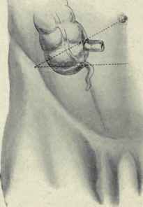 Fig. 423. The relations of the appendix. The ileocaecal junction is seen to be about one inch below the middle of a line joining the anterior superior spine and umbilicus or where this line crosses the linea semilunaris. The base of the appendix is under the point of crossing of the linea semilunaris and the middle of a horizontal line running from the anterior superior spine to the mid line of the body; it is one inch below the ileocaecal junction.