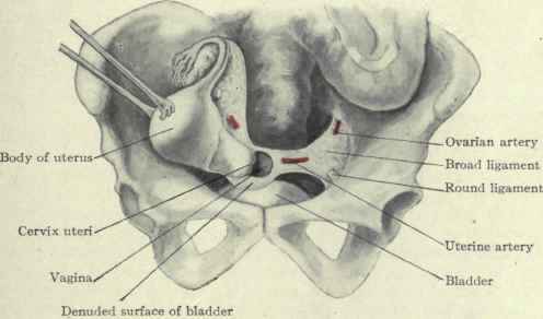 Fig. 464. Removal of the entire uterus.