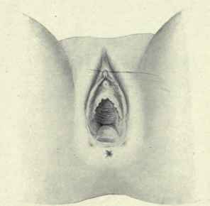 Fig. 468. Rupture of the perineum. The vulva gapes, showing the rectum bulging forward; the two dimples, one on each side of the anus, are caused by the retracted muscles.