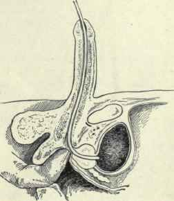Fig. 474. Method of passing the sound. The index finger in the rectum is guiding the sound through the membranous urethra.