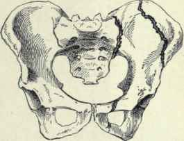 Fig. 493. Diagram illustrating fracture of the pelvis; one fracture is seen passing through the ilium; the other passes through the sacro iliac articulation posteriorly and the thyroid foramen anteriorly.