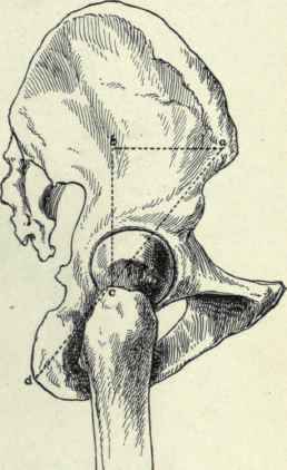 Fig. 507. View of the outer surface of the bones of the hip showing Roser Nelaton line (a d). Bryant's triangle (a b c), iliotrochanteric line, (a c) and the iliotrochanteric angle (b a c).