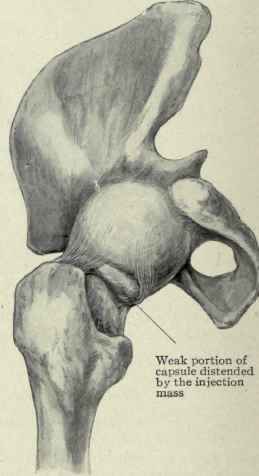 Fig. 511. Hip joint distended with wax; the capsule ends posteriorly half way down the neck and is seen distended by the injection material protruding between the two arms of the ischiofemoral ligament.