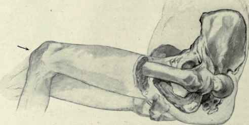 Fig. 515. Posterior luxation of the hip produced by rotation and direct thrust. The femur is seen to be flexed on the pelvis, adducted and rotated inward; a thrust in the direction of the arrow then sends the head out of the acetabulum onto the posterior plane.