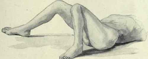 Fig. 517.   Posterior or dorsal luxation of the left hip (From an original sketch by the author). The shortening is seen by comparing the position of the knees, the thigh is adducted and rotated inward.