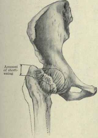 Fig. 538. Intracapsular fracture of the neck of the femur showing the shortening. The dotted line represents the outline of the normal bone.