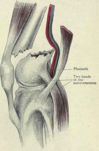 Fig. 541. Supracondylar fracture of the femur. The lower fragment is seen to be drawn back into the popliteal space by the gastrocnemius and plantaris. The vessels are stretched over the sharp edge of the lower fragment.