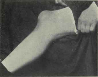 Fig. 550. Housemaid's knee or enlargement of the prepatellar bursa.