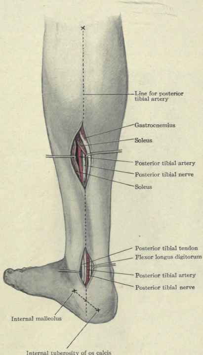 Fig. 562. Ligation of the posterior tibial artery.