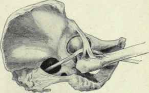 Fig. 5i6.   Showing the sciatic nerve caught around the neck of the femur. (After an illustration by Dr. Allis in his prize essay on the hip).