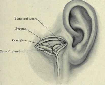 Fig. 84. Excision of the condyle of the lower jaw.